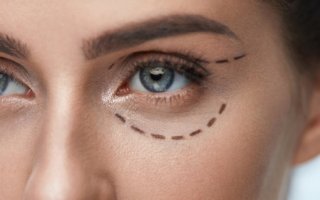 Кантопексия или блефаропластика – в чем разница?