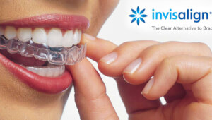 Invisalign: современный подход к исправлению прикуса
