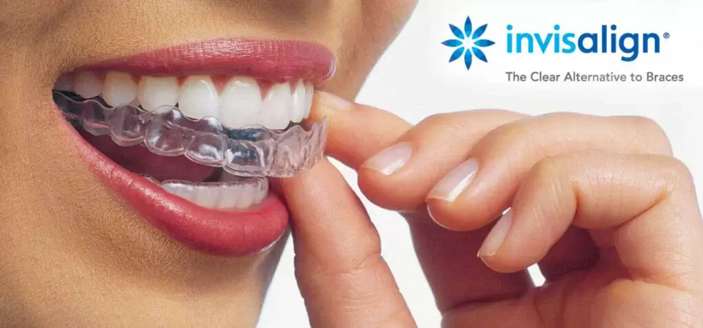 Invisalign: современный подход к исправлению прикуса