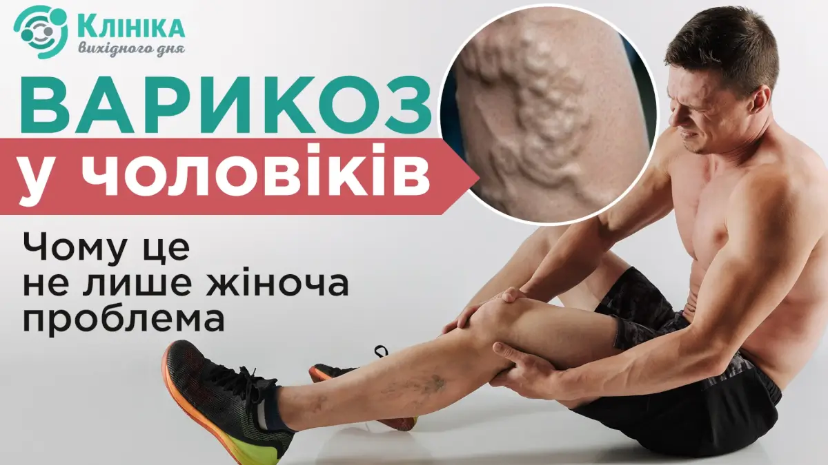 Варикоз у чоловіків: чому це не лише жіноча проблема